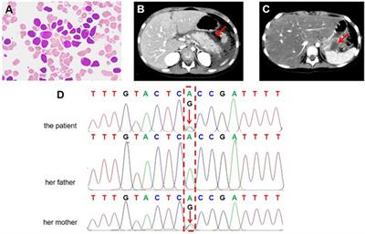 Acute pancreatitis following asparaginase treatment in pediatric acute lymphoblastic leukemia with a heterozygous SPINK1 c.194 + 2T>C intronic variant: a case report